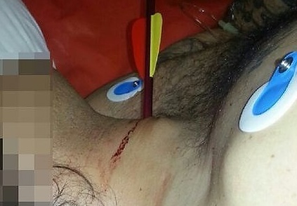 In ospedale con una freccia nel collo