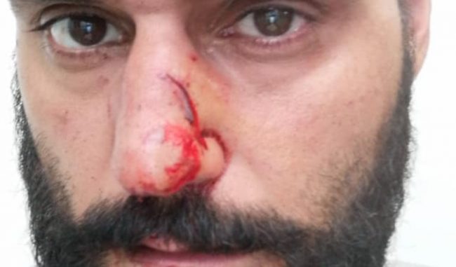 Colpito al volto dallo specchietto dopo l’incidente. Offerta ricompensa a chi trova il “colpevole”