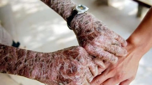 Nuova droga russa causa pelle di coccodrillo, operazione dei carabinieri di Venaria | VIDEO