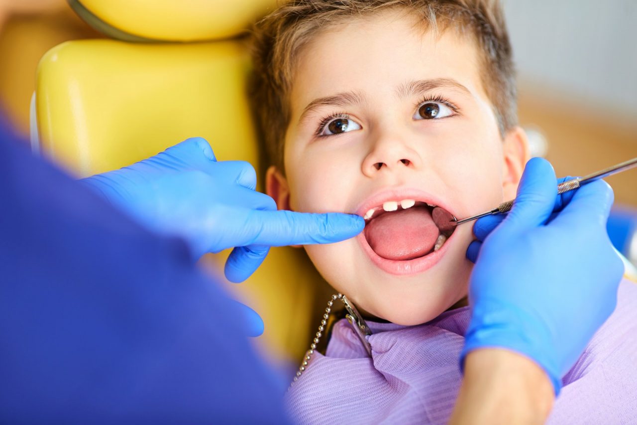 Malocclusioni dentali nei bambini: da cosa dipendono e come si curano