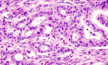 Tumore al pancreas: trovata la chiave per aprire la “porta” ai linfociti che eliminano i tessuti malati