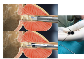 Prostata con il laser la sessualità è salva