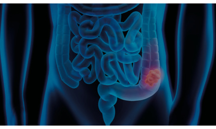 Screening dei tumori del colon-retto, ampliata la fascia d’età