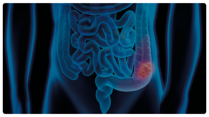 Screening dei tumori del colon-retto, ampliata la fascia d’età